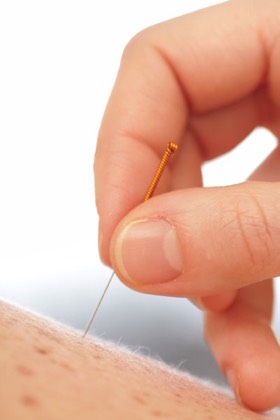 Dry needling technique for triggerpoints headache and migraine